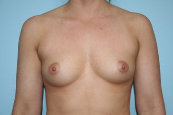 Breast Augmentation with Allergan 410 Implants before 1084100