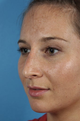 Non-surgical Rhinoplasty 1108783