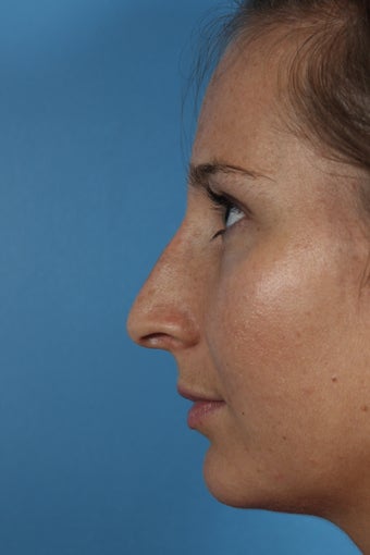 Non-surgical Rhinoplasty after 1108783