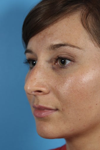 Non-surgical Rhinoplasty 1108783