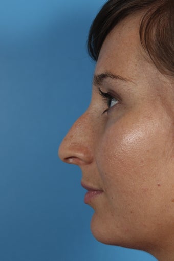Non-surgical Rhinoplasty before 1108783