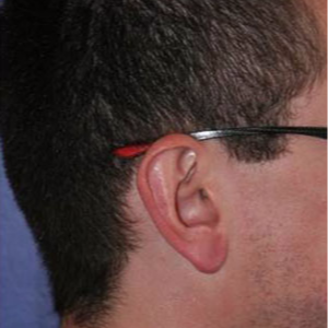 Ear Lobe Surgery after 3710618