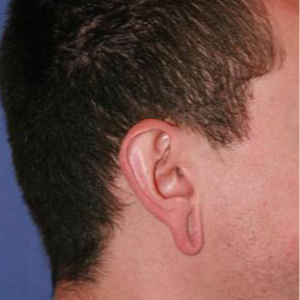 Ear Lobe Surgery before 3710618