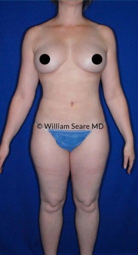 45-54 year old woman treated with Tumescent Liposuction after 3079997