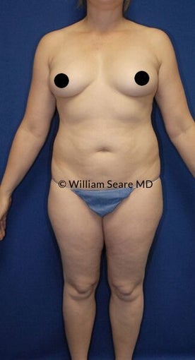 45-54 year old woman treated with Tumescent Liposuction before 3079997