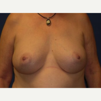 25-34 year old woman treated with Breast Augmentation after 3220084