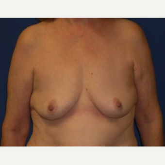 25-34 year old woman treated with Breast Augmentation before 3220084
