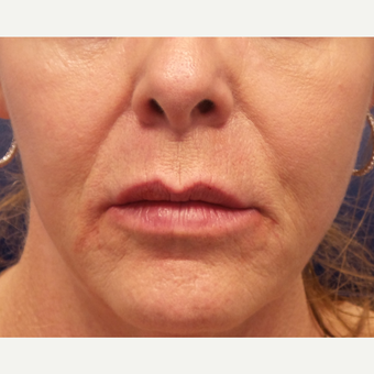 55-64 year old woman treated with Lip Augmentation after 3675163