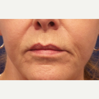 55-64 year old woman treated with Lip Augmentation before 3675163