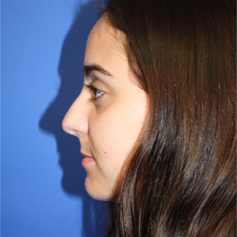 18-24 year old woman treated with Rhinoplasty before 3399636