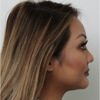 25-34 year old woman treated with Revision Rhinoplasty after 3583593