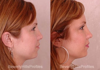 Revision Rhinoplasty before 681866