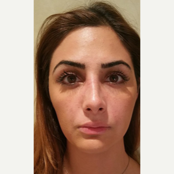25-34 year old woman treated with Rhinoplasty after 3687084