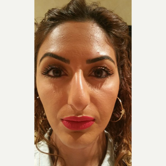 25-34 year old woman treated with Rhinoplasty before 3687084