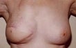 62 year old female patient after 934527
