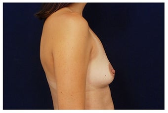 Breast Augmentation before 1335746