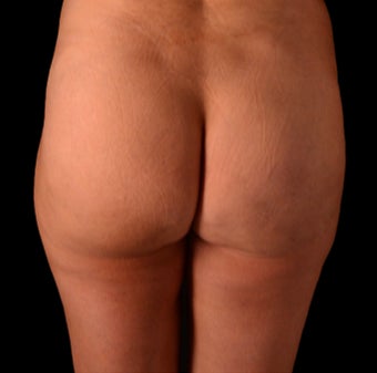 35-44 year old woman treated with Cellfina after 3220364