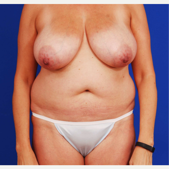 45-54 year old woman treated with Mommy Makeover before 3731088