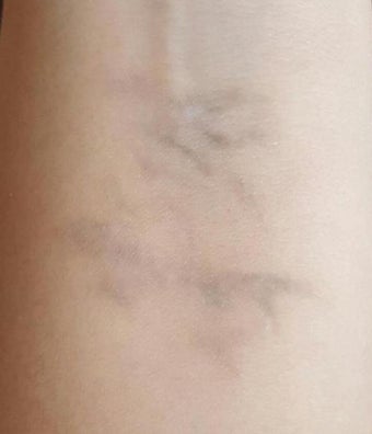 25-34 year old woman treated with PicoSure Tattoo Removal after 3246659