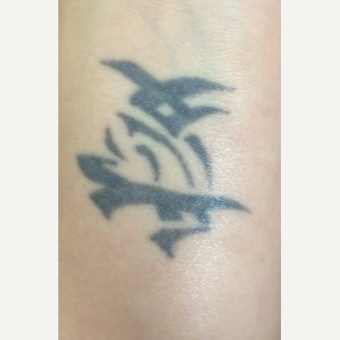 25-34 year old woman treated with PicoSure Tattoo Removal before 3246659