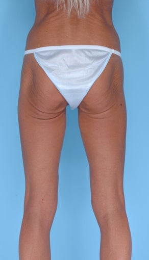49 Year Old Female Treated with Lateral Thigh Lift before 1061767