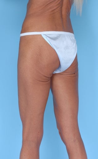 49 Year Old Female Treated with Lateral Thigh Lift 1061767