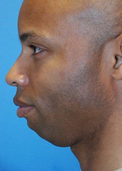 Chin implant 199371