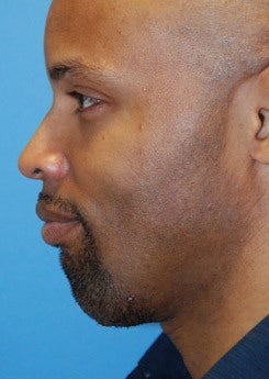 Chin implant 199371