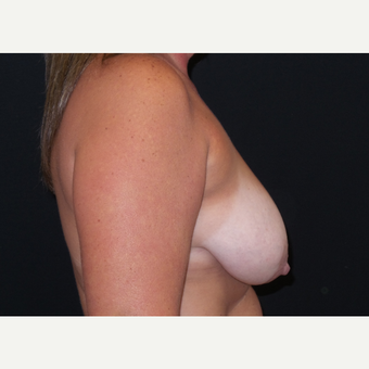 35-44 year old woman treated with Breast Lift with Implants before 3305195