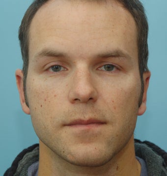 Otoplasty after 271695