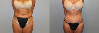 54 Year Old Female With Abdominal Rejuvenation Following Two Children after 1190520