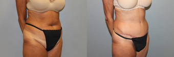 54 Year Old Female With Abdominal Rejuvenation Following Two Children before 1190520