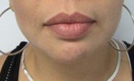 Chin Liposuction after 3141650
