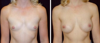 29 year old female, breast augmentation, San Francisco, California before 628398
