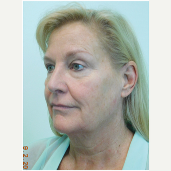 55-64 year old woman treated with Facelift, Fat Grafting, and Lower Eye Laser before 3670701