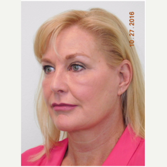 55-64 year old woman treated with Facelift, Fat Grafting, and Lower Eye Laser after 3670701