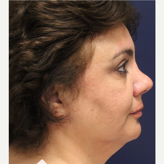 45-54 year old woman treated with Smart Lipo before 3143479