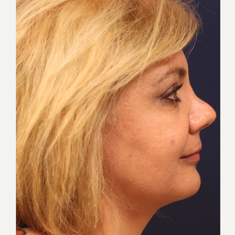 45-54 year old woman treated with Smart Lipo after 3143479