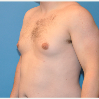 25-34 year old man treated with Male Breast Reduction before 3705410