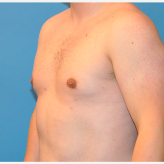 25-34 year old man treated with Male Breast Reduction after 3705410