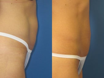 Exilis for skin tightening abdomen 938960