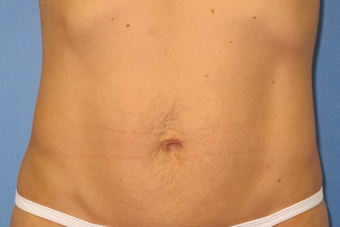 Exilis for skin tightening abdomen after 938960