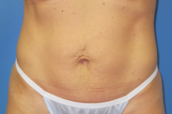 Exilis for skin tightening abdomen before 938960