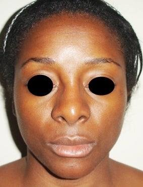 36 year old female treated with open rhinoplasty before 1096623