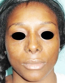 36 year old female treated with open rhinoplasty after 1096623