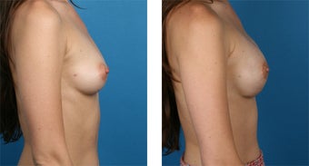 29 Year Old Woman, Cassileth One-Stage Breast Reconstruction after 1039911