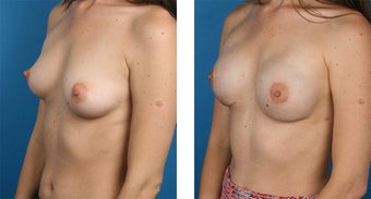 29 Year Old Woman, Cassileth One-Stage Breast Reconstruction 1039911