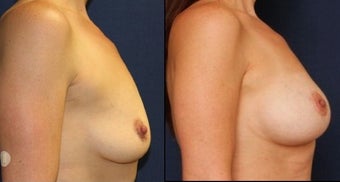 42 year woman breast augmentation and breast lift before 1254239