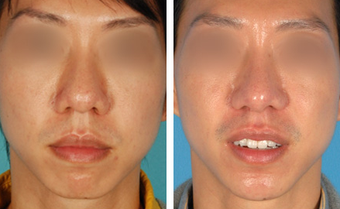 Chin Surgery before 1208029
