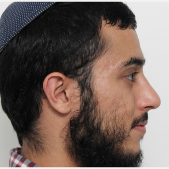 18-24 year old man treated with Rhinoplasty after 3448594